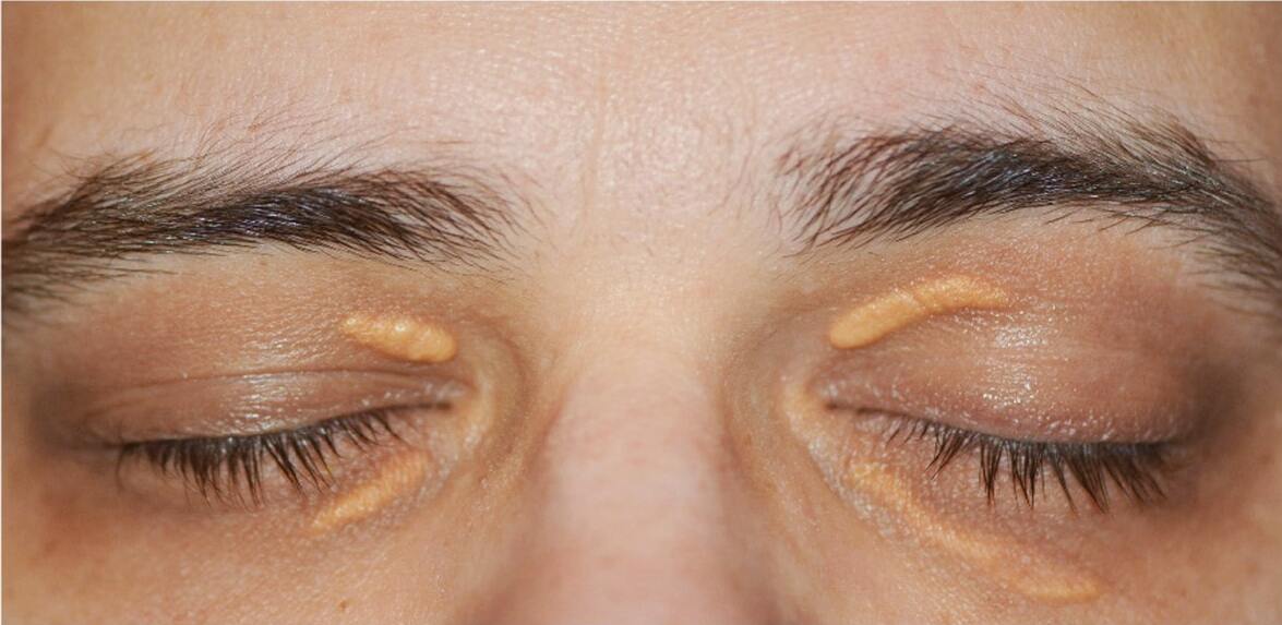 Xanthelasma in eye